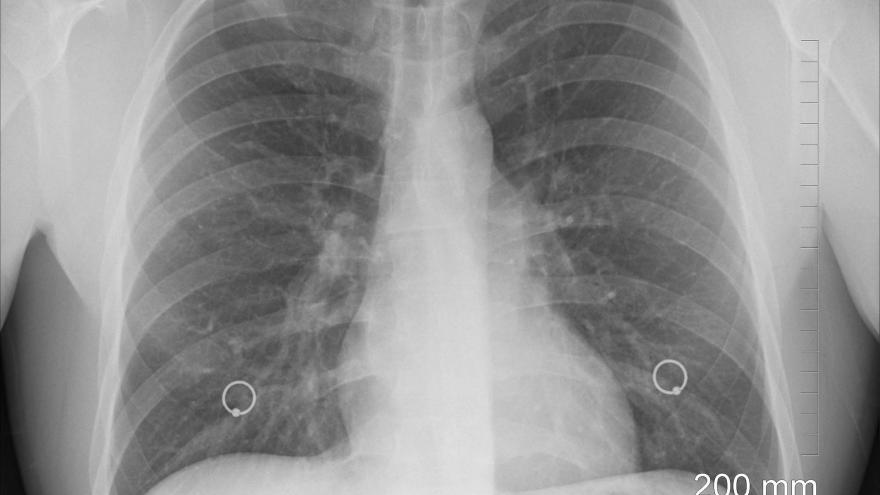 Hipertensión Arterial Pulmonar