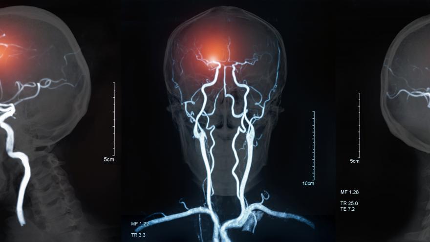 Ictus cerebral