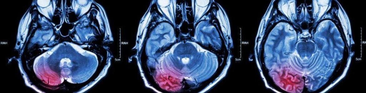 Tumores Cerebrales del adulto