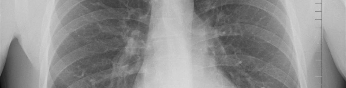 Hipertensión Arterial Pulmonar
