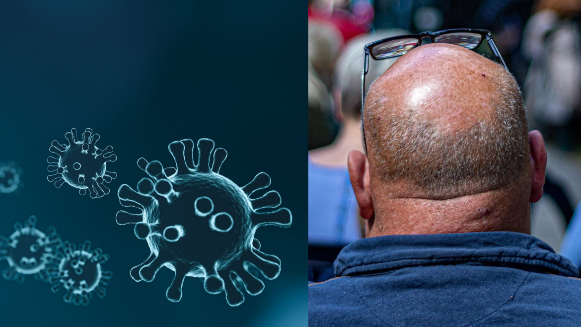 Imagen representativa de coronavirus y de un varón con alopecia