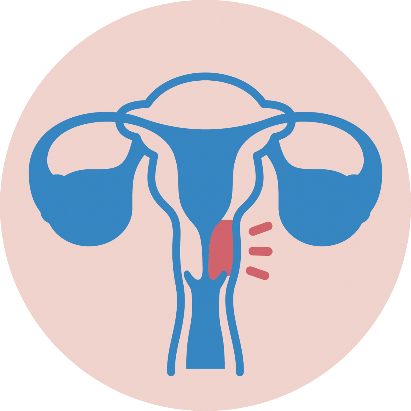 Esquema de útero y ovarios con zona de cuello marcada en rojo