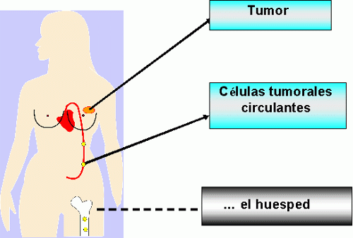 imagen de un cuerpo humano y células cancerosas en diseminación